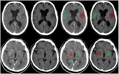 Value of Dual-Energy Dual-Layer CT After Mechanical Recanalization for the Quantification of Ischemic Brain Edema